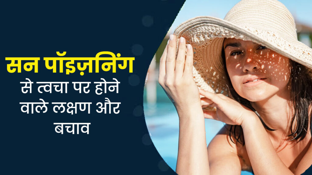 क्या है Sunburn और Sun Poisoning जो गर्मियों में पहुंचा सकते हैं त्वचा को गंभीर नुकसान, जानें कैसे करें बचाव